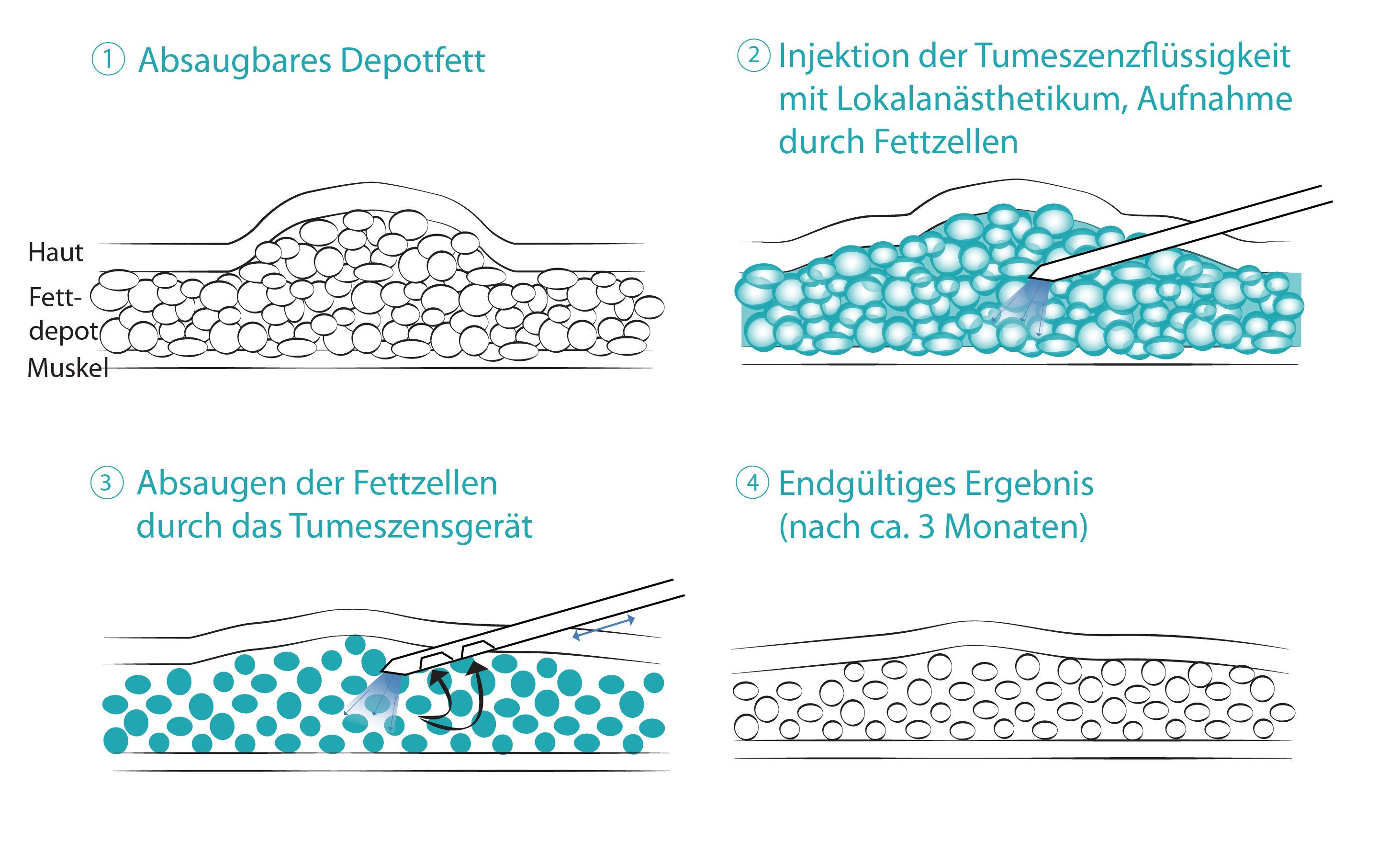 Illustration zum Ablauf einer Fettabsaugung